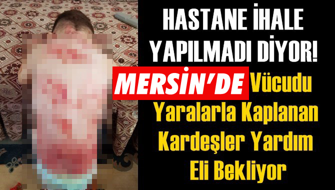 Mersin'de Vücudu Yaralarla Kaplanan Kardeşler Yardım Eli Bekliyor